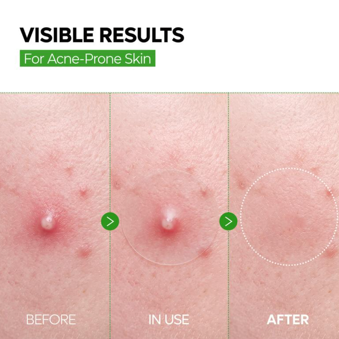 Aevion Health's Advanced Pimple Patch